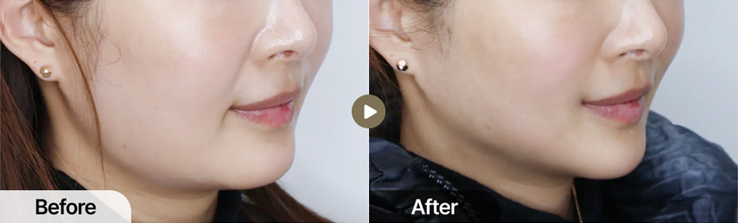 전후사진